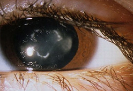 Catarata Congénita img