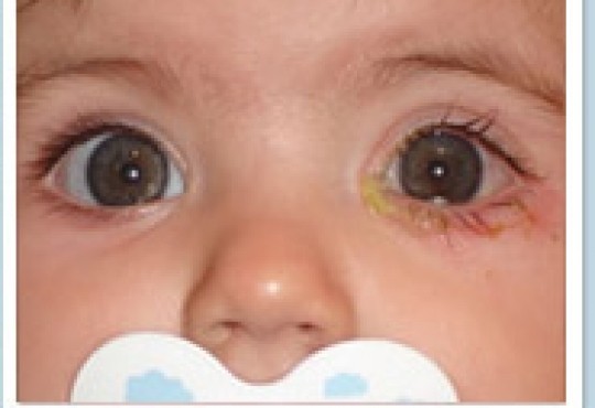 Obtruccions lagrimal recien nacido img