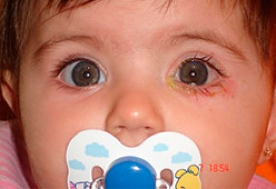 Obtrucció del lagrimal Congénito img